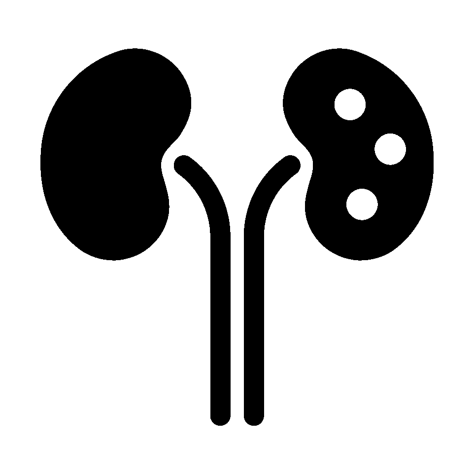 Kidney Stones