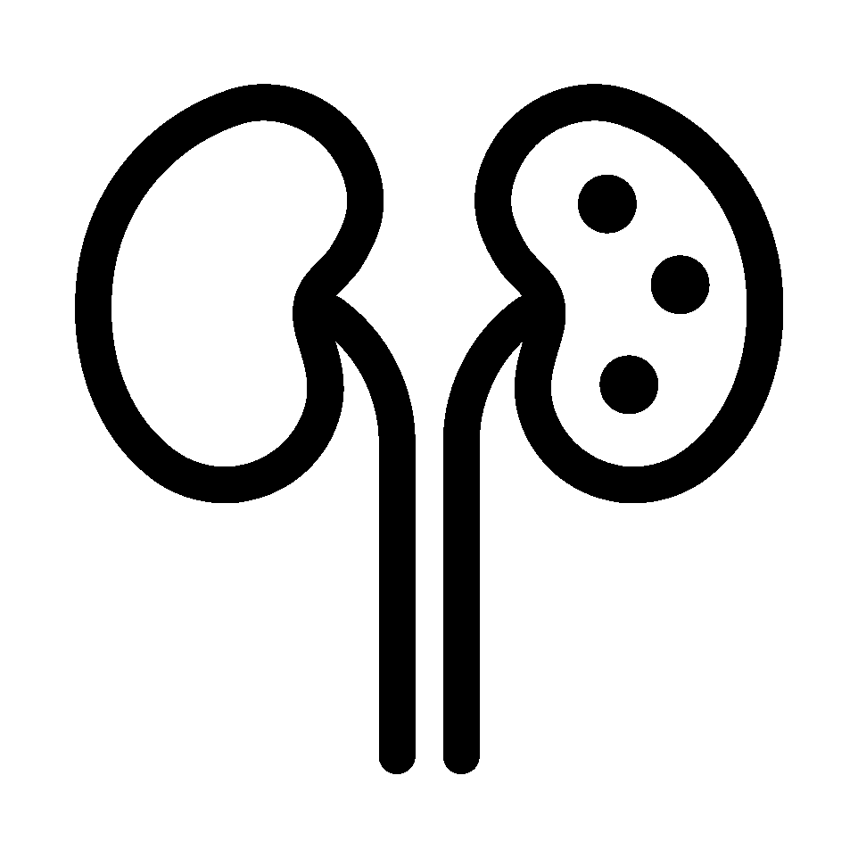 Kidney Stones